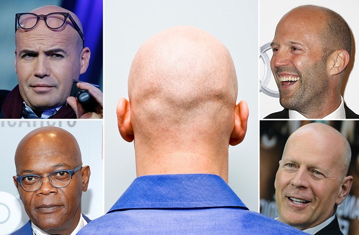 Why do we go bald? Scientists can now finally explain it